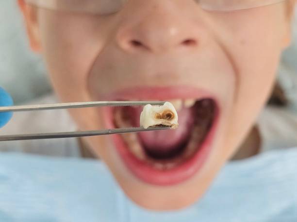 Best Urgent Care for Lost Fillings or Crowns in Canby, OR